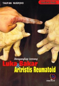 Image of Luka bakar dan artritis reumatoid
